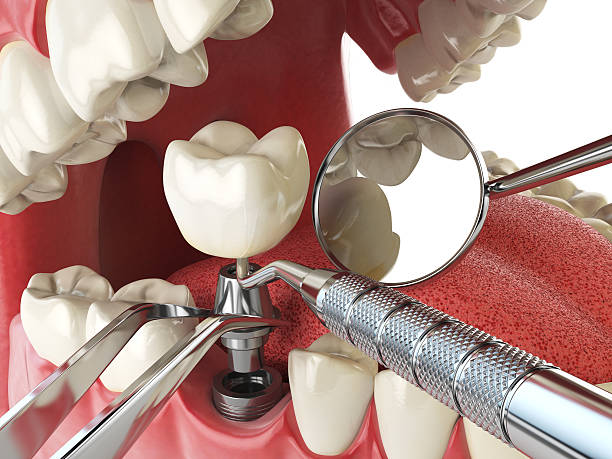 Best Emergency Treatment for Oral Infections in Laurel, MS